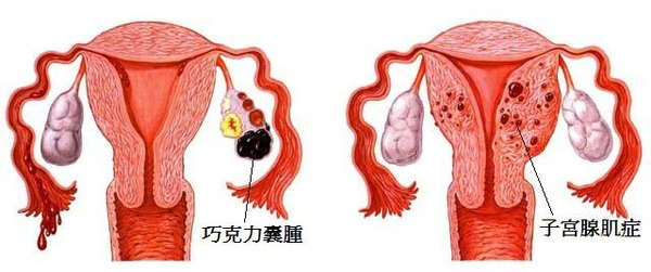 巧克力囊腫、子宮腺肌症